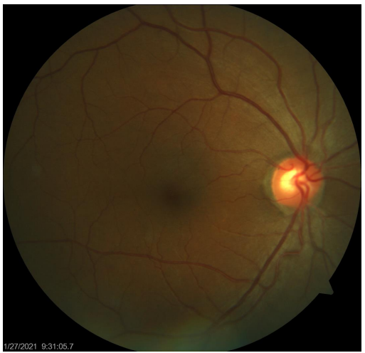 Foto fundus retina tanpa tanda retinopati, dari modul simulasi grading kursus DRIVE.