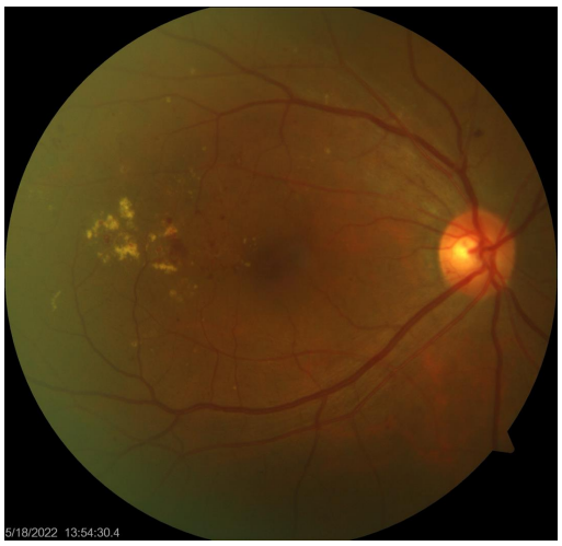 Foto fundus retina dengan perdarahan dot, hard exudate dan neovaskularisasi.
